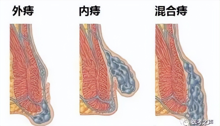 节后安全防范要怎么抓,疫情期间痔疮怎么锻炼恢复