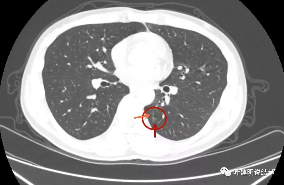 这样的多发病灶给试验性抗结核治疗?消失的结节是药的功劳吗?