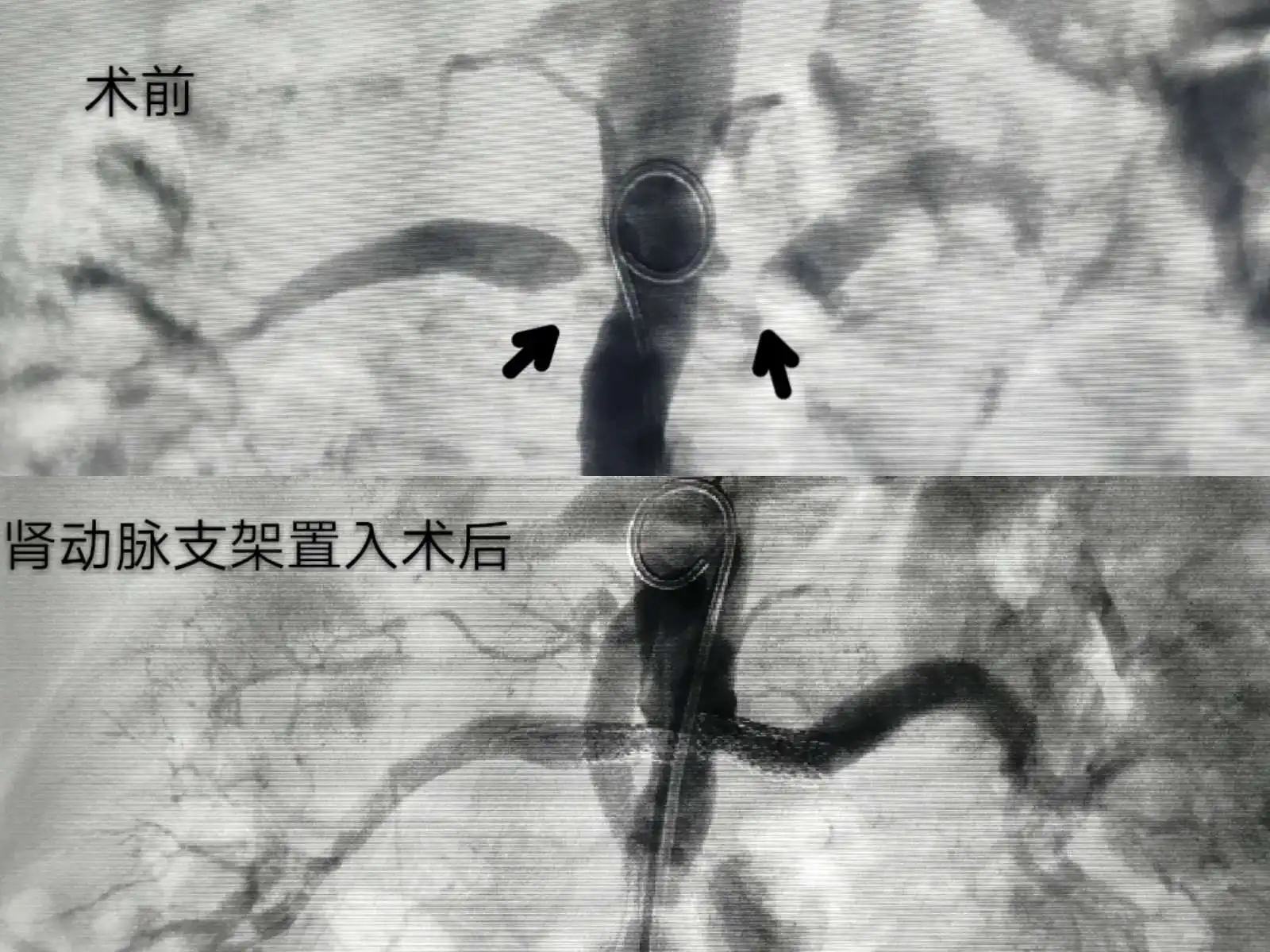药物涂层球囊和支架哪种好,心梗用药物球囊好还是支架好