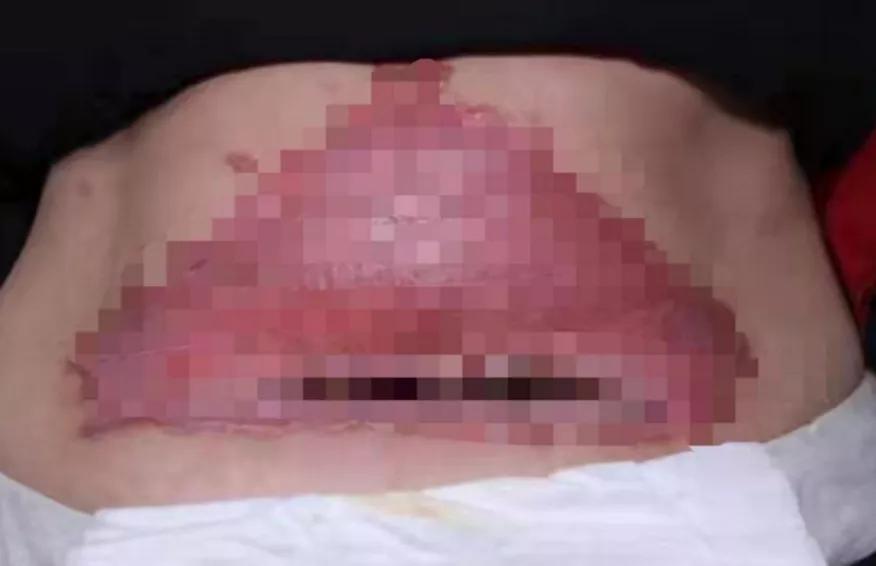 肚子里长溃疡动手术,全腹部发炎怎么治疗