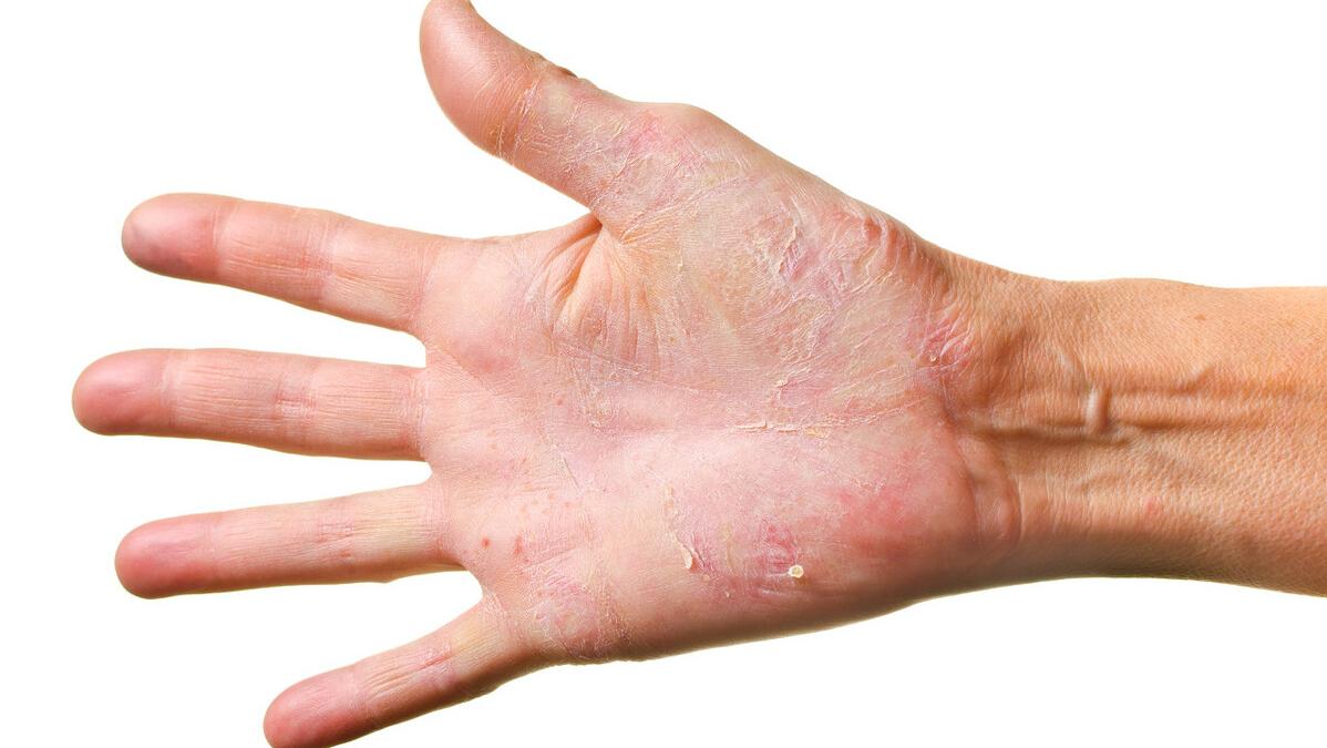 湿疹特别痒用什么药最有效,湿疹很痒用什么药膏最有效