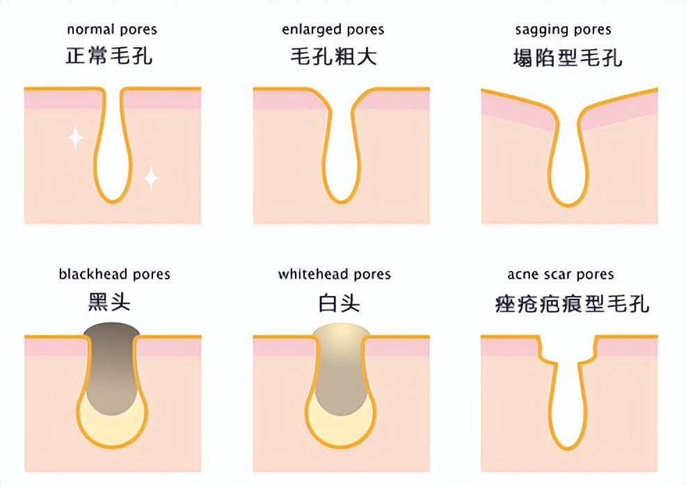收缩毛孔粗大的方法,脸毛孔粗大的正确护肤方法