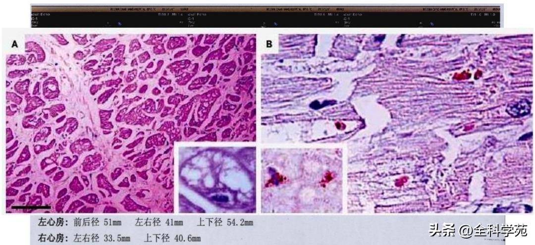 t波倒置三种常见原因,t波低平倒置有事吗