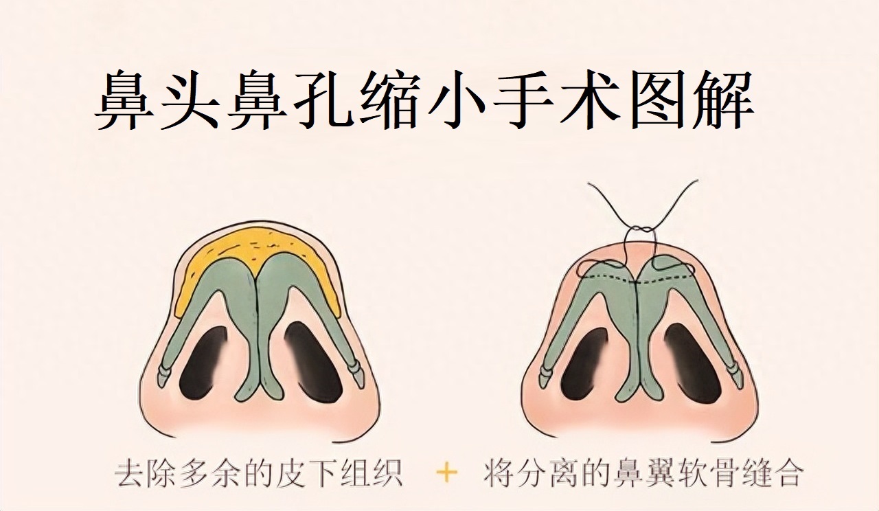 怎样让鼻孔自然缩小,缩小鼻孔自然方法图解