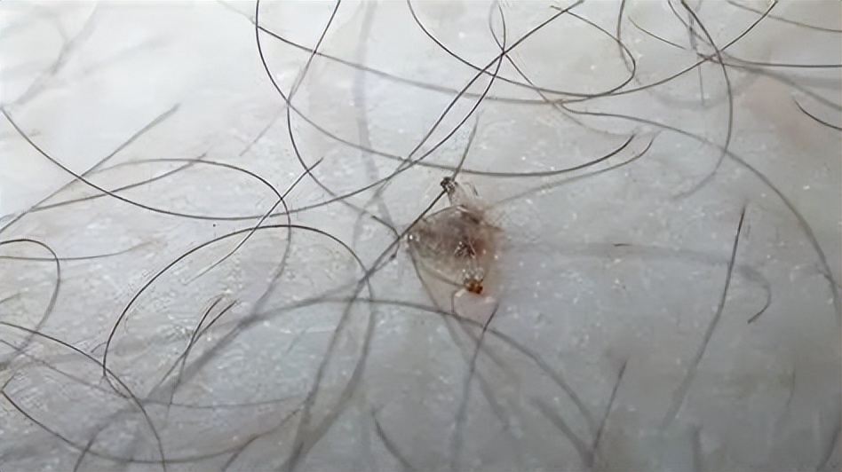 关于阴虱的预防方法有哪些,怎么注意阴虱的传播