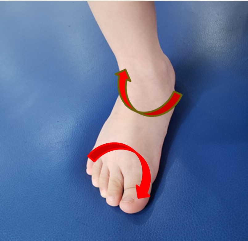 小孩子多大需要干预扁平足,8岁女孩扁平足需要干预吗