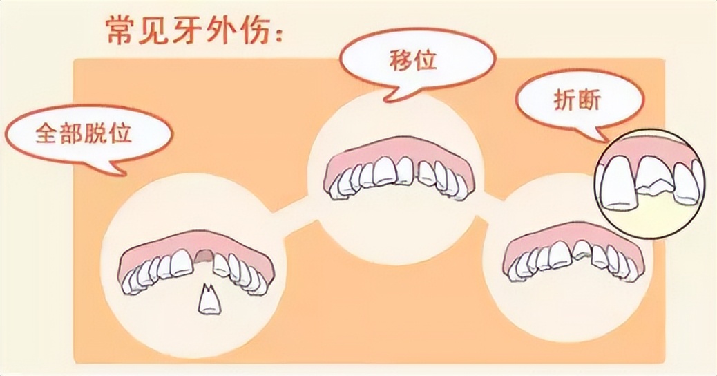 摔了一跤牙碰了半年还隐隐痛,摔了一跤牙齿磨掉了