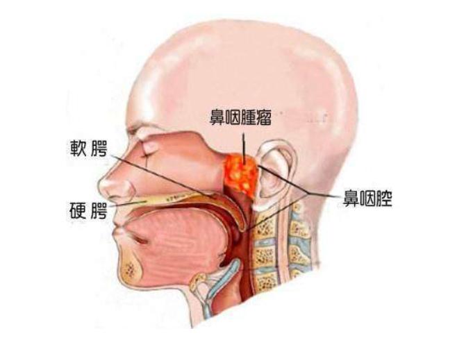 鼻咽癌精准放疗质子治疗费用,鼻咽癌首选放疗还是化疗