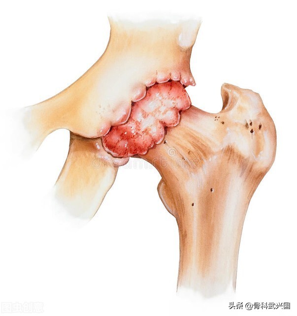 女人颈椎有骨刺为什么引起背痛,背痛是不是长骨刺的原因