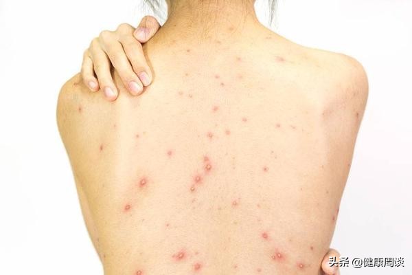 毛囊炎与青春痘如何区分,头上很多红色的痘痘毛囊炎