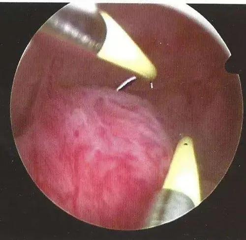 好好的子宫内膜，怎么就长了“多肉”？