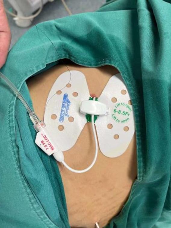 直肠癌转移的方式,直肠癌转移盆腔化疗方案