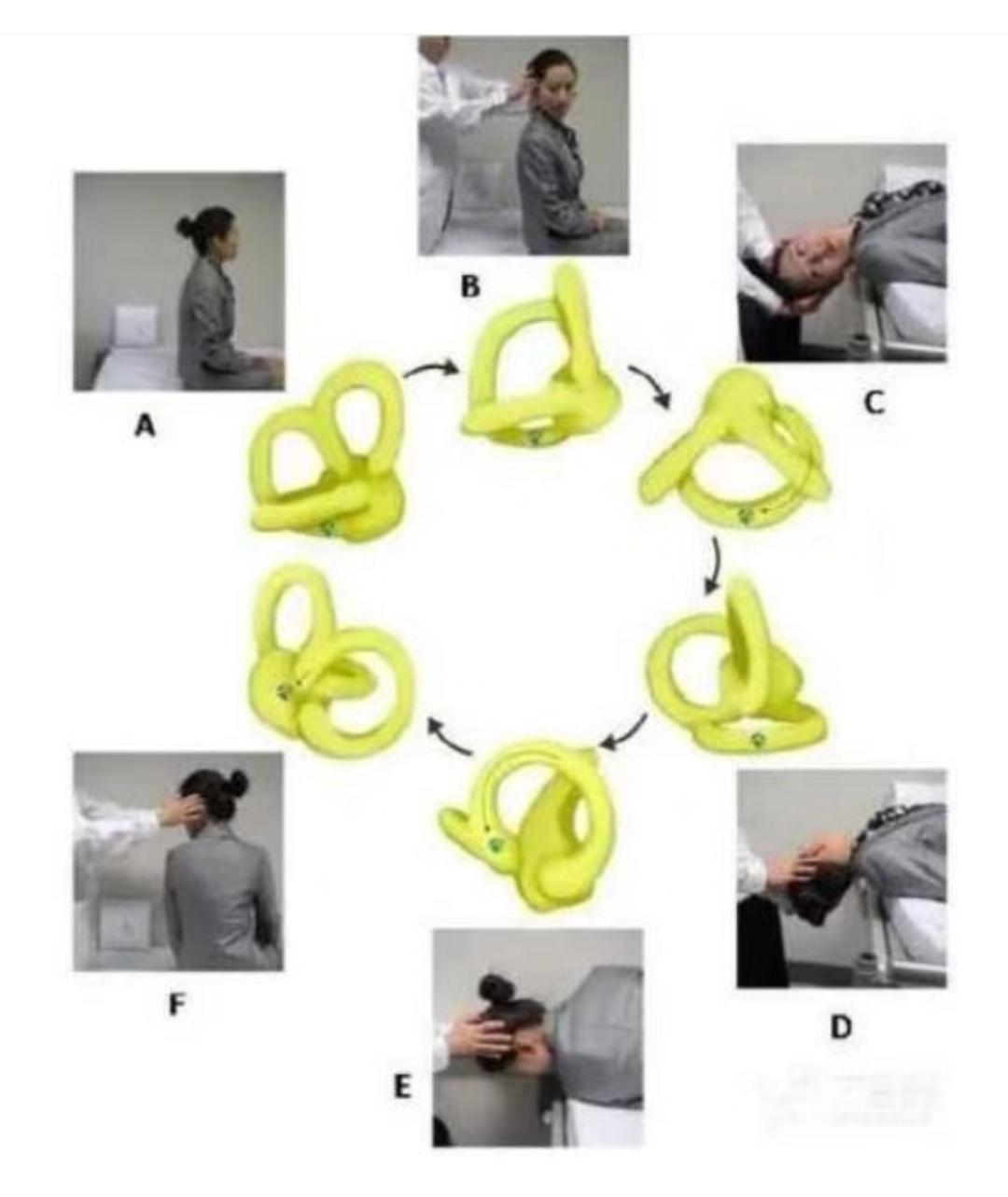 耳石症医生复位手法视频,耳石症复位神经科