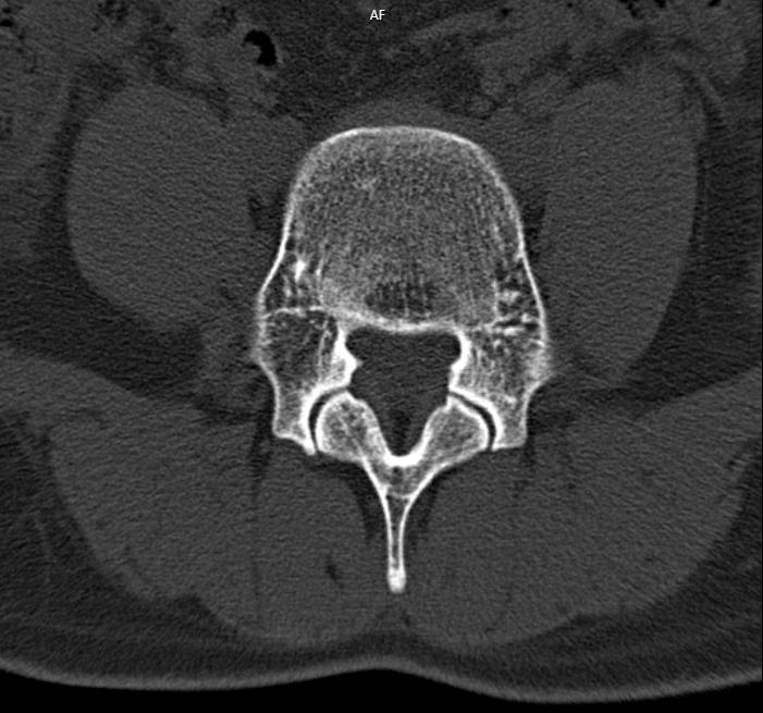 腰突压迫硬膜囊会出现什么症状,腰突压迫硬膜囊怎么恢复