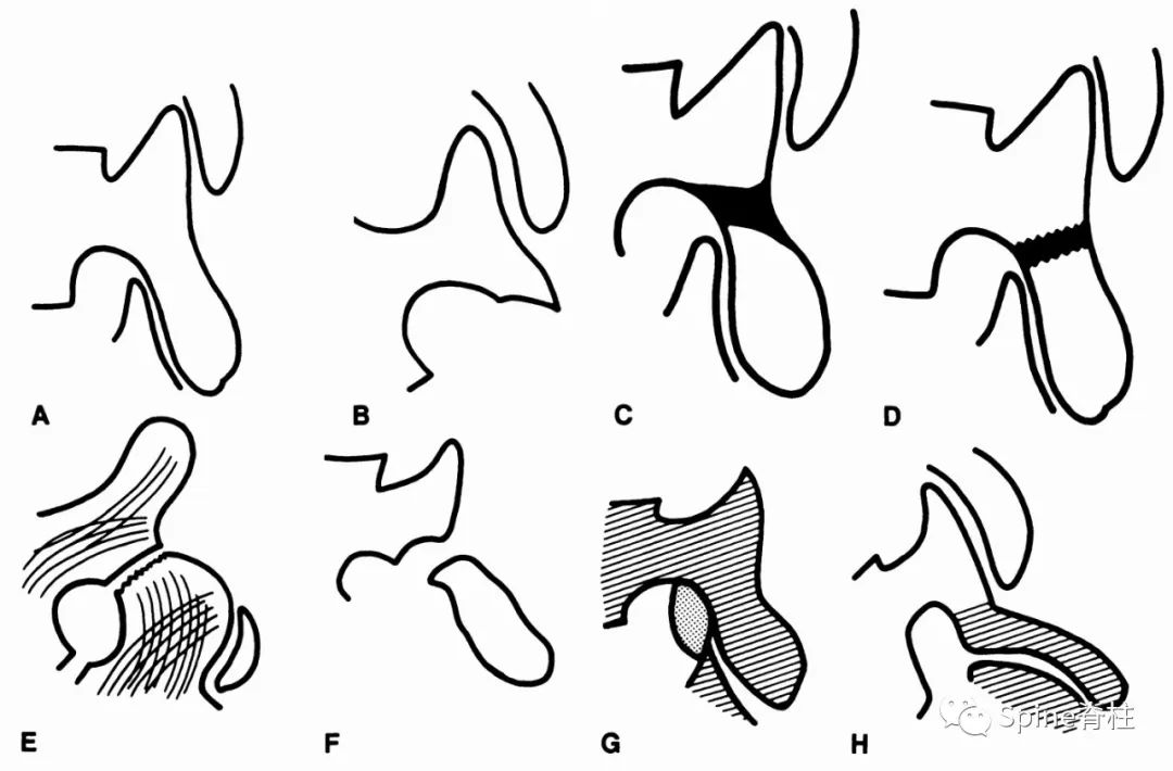 峡部裂和隐性峡部裂有区别吗,单纯峡部裂可以做峡部修复吗