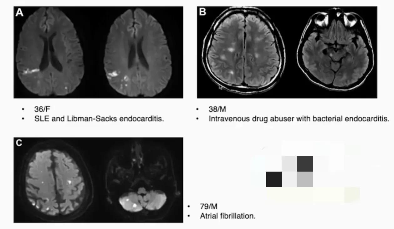 缺血性卒中治疗原则,缺血性卒中病因分型