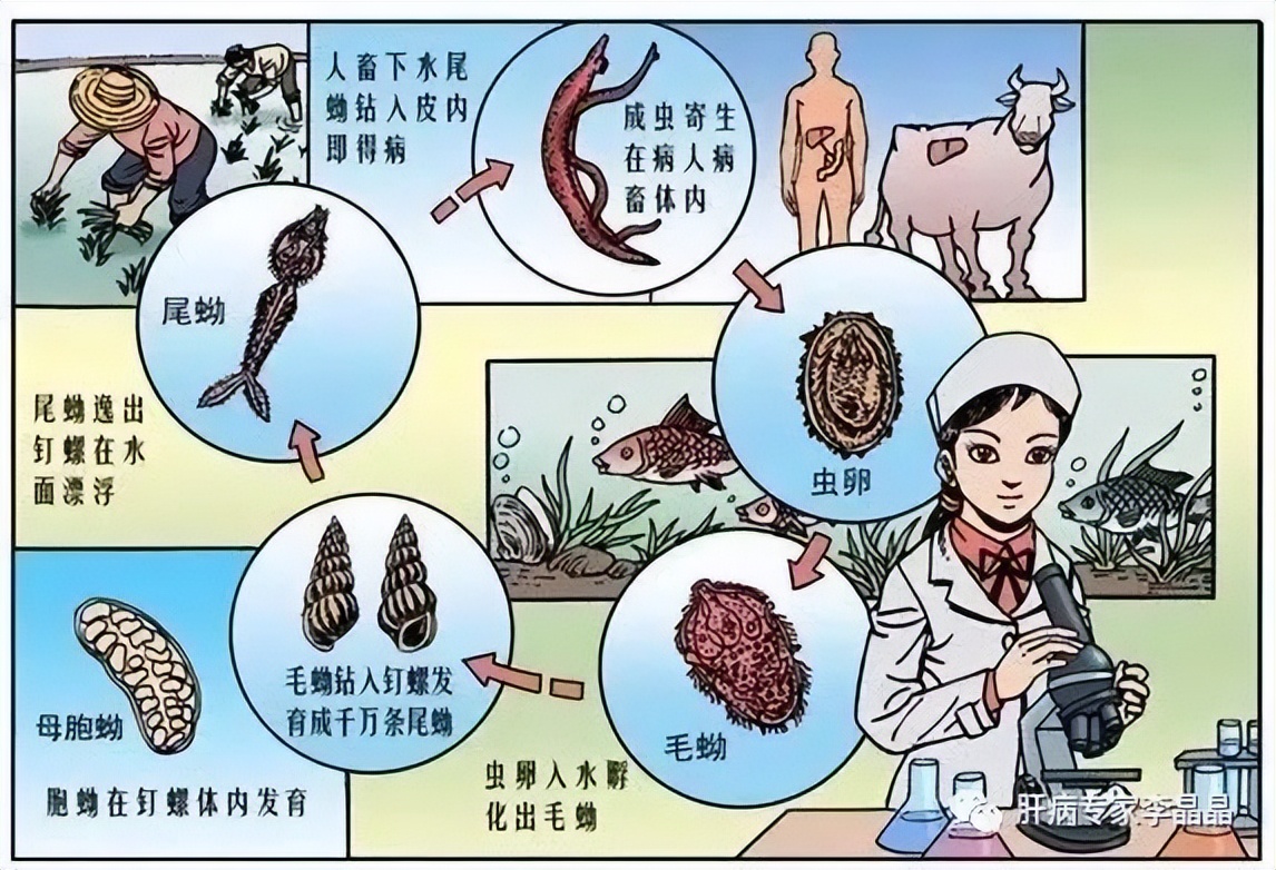 血吸虫病导致肝硬化的机理,血吸虫肝硬化患者出现腹水原因