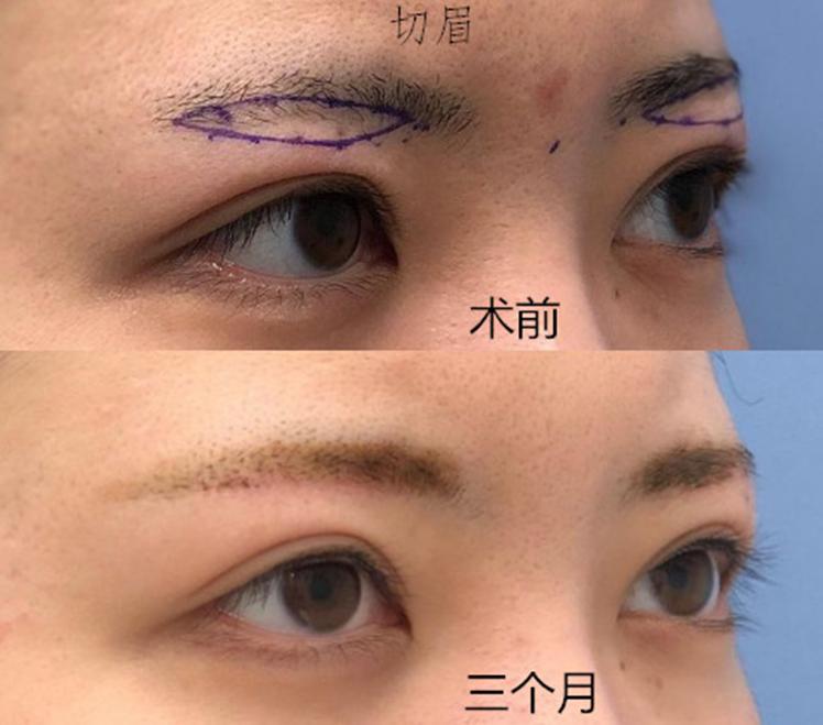 切眉和提眉哪个效果好有副作用吗,想做提眉和眼袋手术