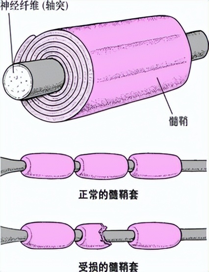 脱髓鞘病变是不是真的很严重,脱髓鞘病变属不属于大病