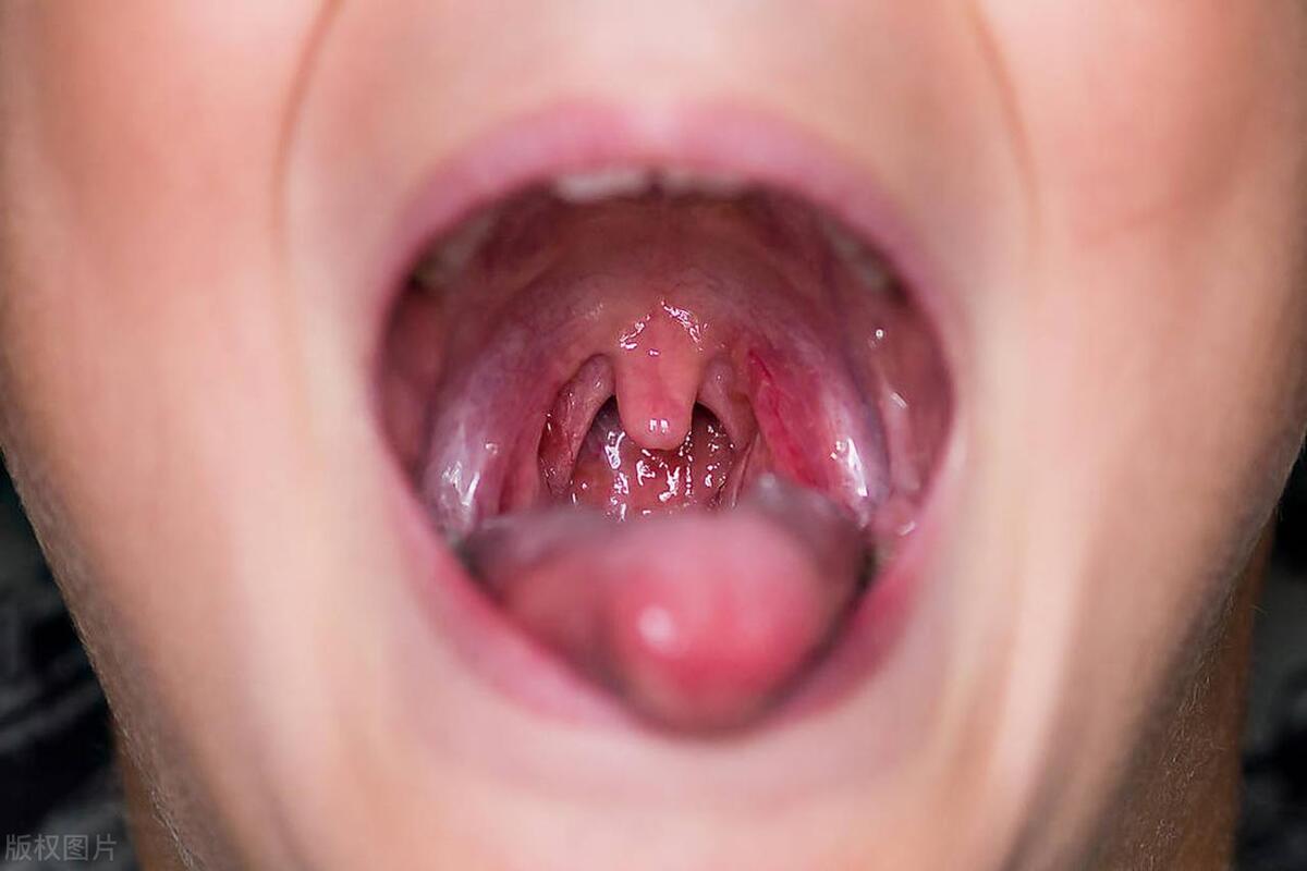 腺样体肥大打针有用吗,儿童腺样体肥大耳朵痛要不要打针