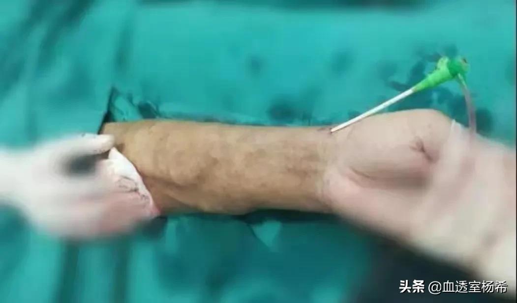 内瘘狭窄的宣教知识,内瘘狭窄吃药能解决吗