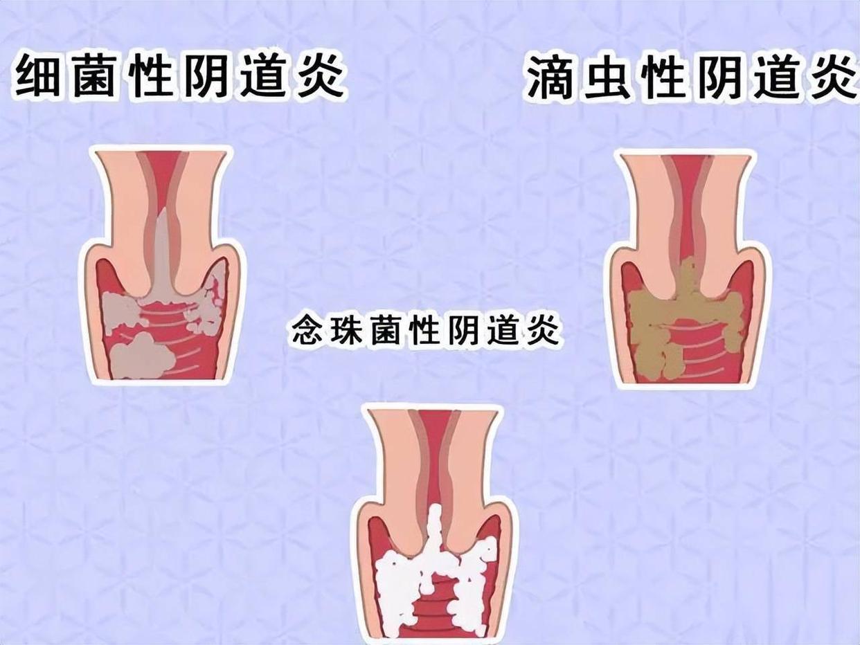 8大性传播疾病,8种心理疾病