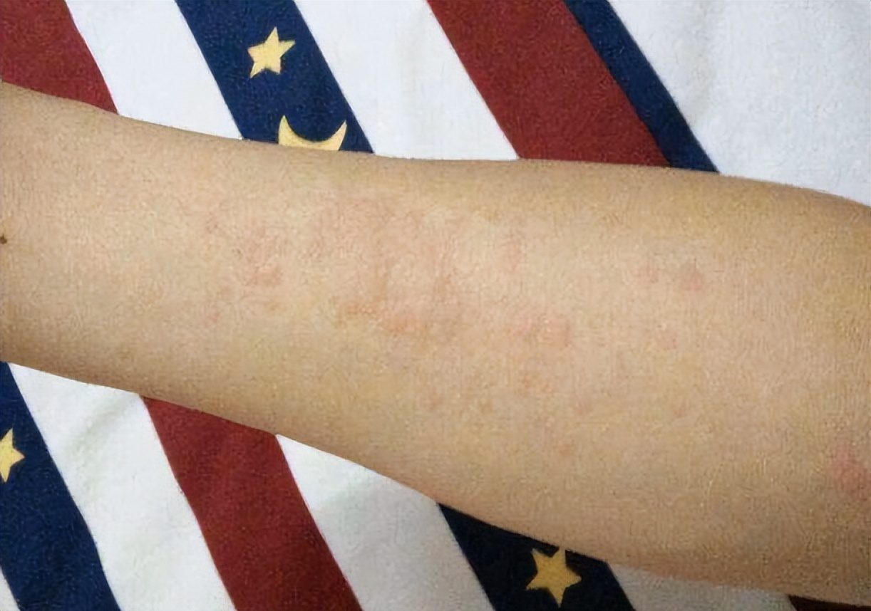 一些奇怪的过敏原,那些千奇百怪的过敏源