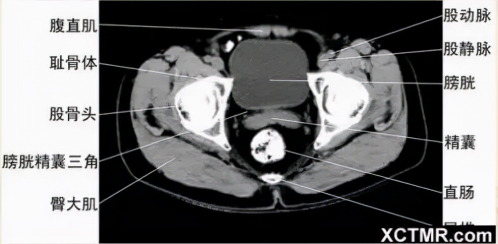胸腹部盆腔ct主要检查什么,女性盆腔ct断层解剖结构图