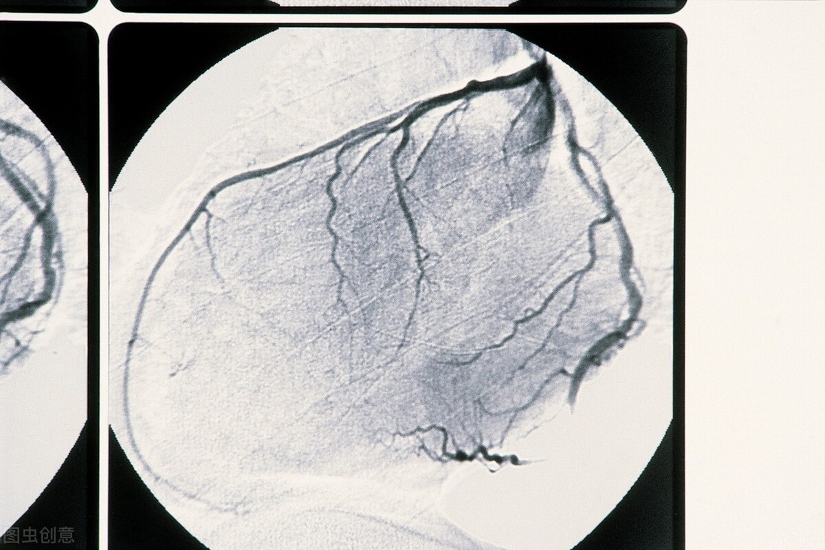 冠心病放支架好还是不好,胸主动脉支架和冠心病支架区别