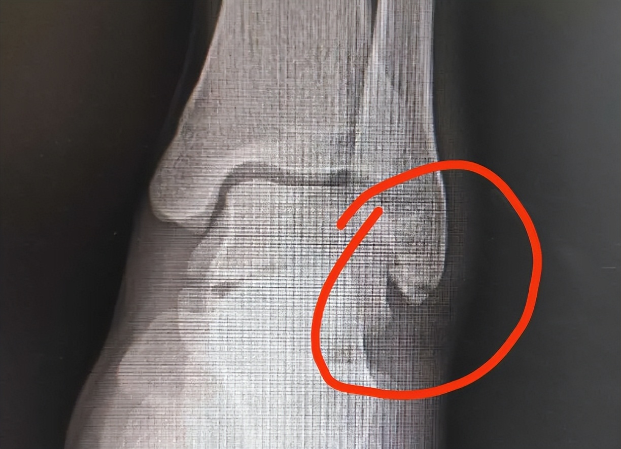 被人打到肌肉拉伤了怎么办,肌肉撕裂自愈过程力气会变小吗