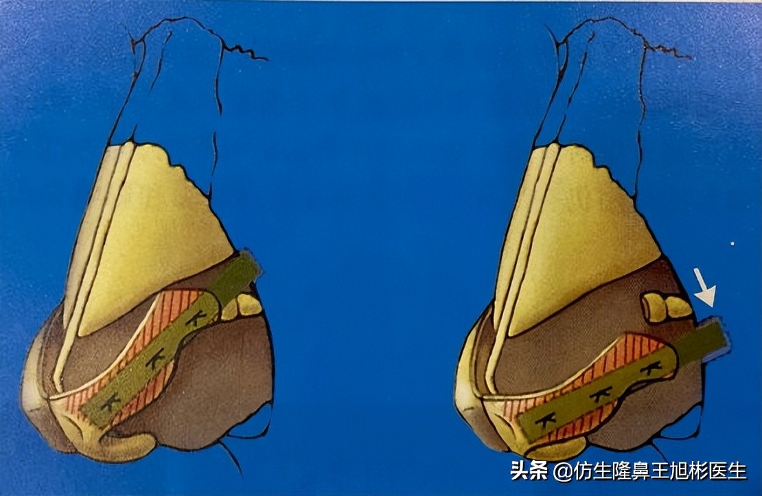鼻头部位整形,鼻头圆钝高鼻梁整形案例