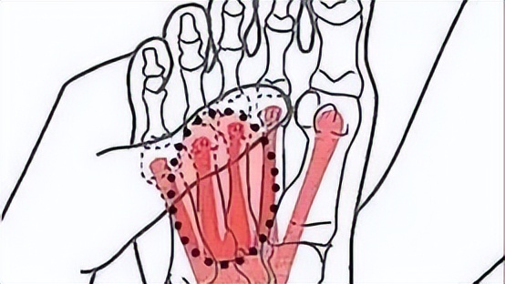 脚底板爱进风什么原因,脚底板走路磨起茧子怎么去