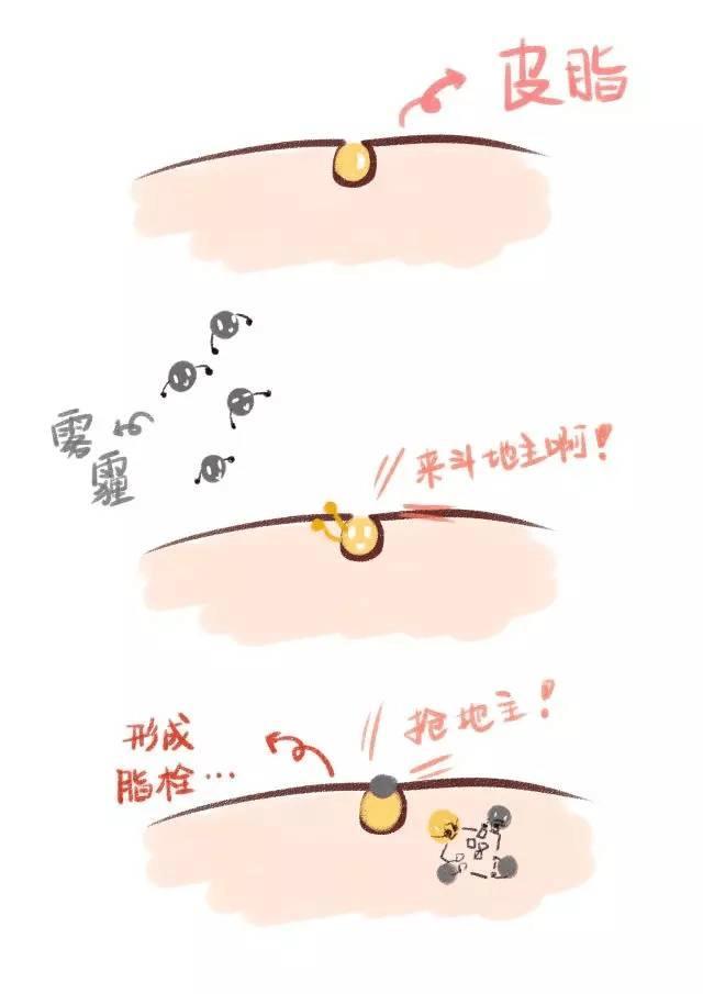 分享简单去黑头的方法,去黑头最有效的方法和攻略