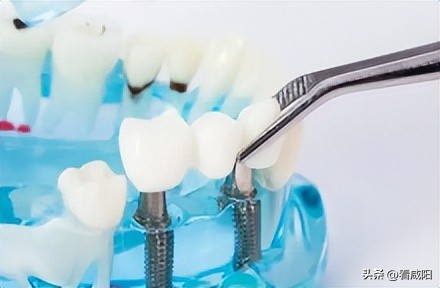 咸阳市口腔种植价格全解析,陕西口腔种植降价