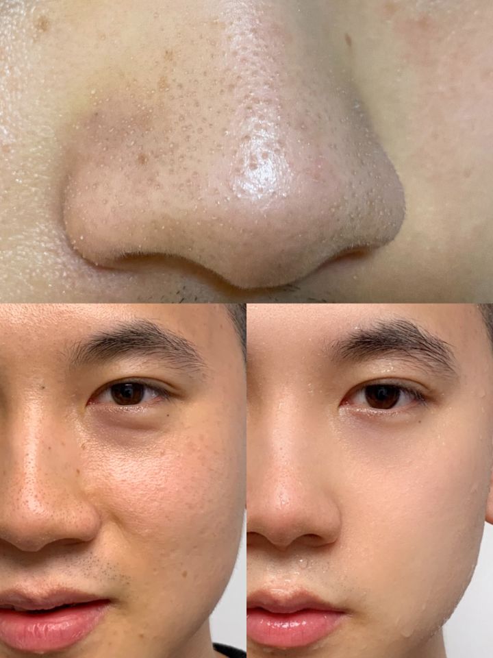 鼻子上的黑头会长毛么,鼻子上的黑头会蔓延到脸上吗