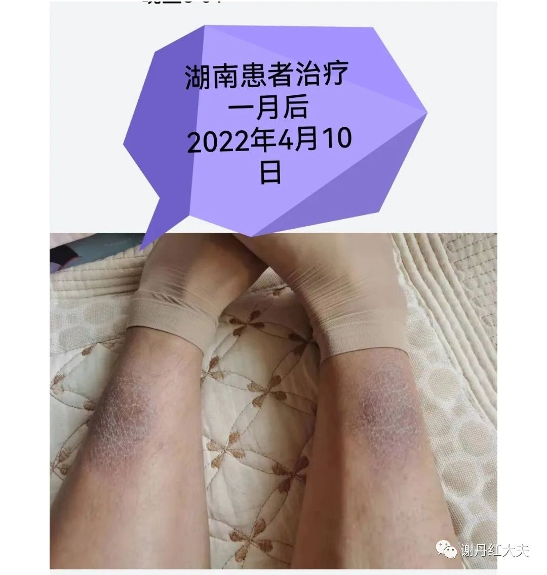 胫前黏液性水肿见于哪些病,胫前黏液性水肿为凹陷性水肿吗