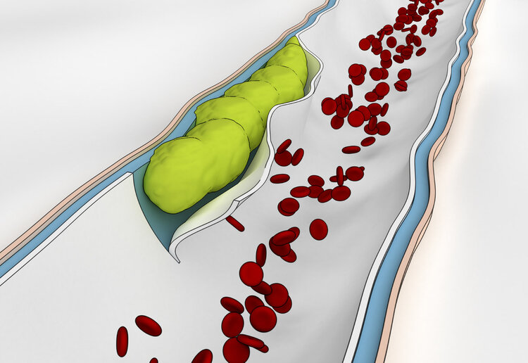左腿静脉血栓最好的解决方案,右下肢静脉血栓可能是癌症吗