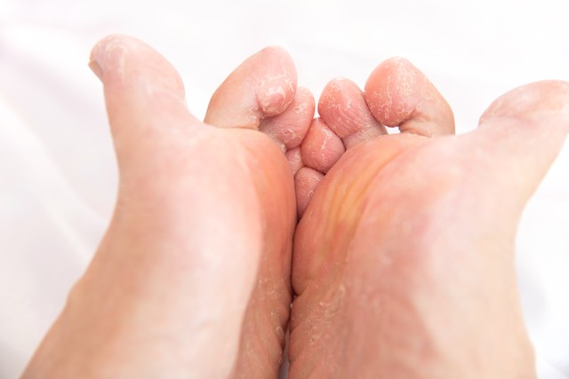 治脚气脚痒脱皮起泡的药材,什么草药治脚气长水泡痒