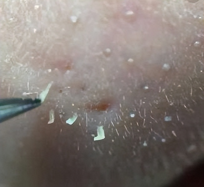 去除鼻子黑头收缩毛孔小妙招,鼻子黑头毛孔大抹什么药膏