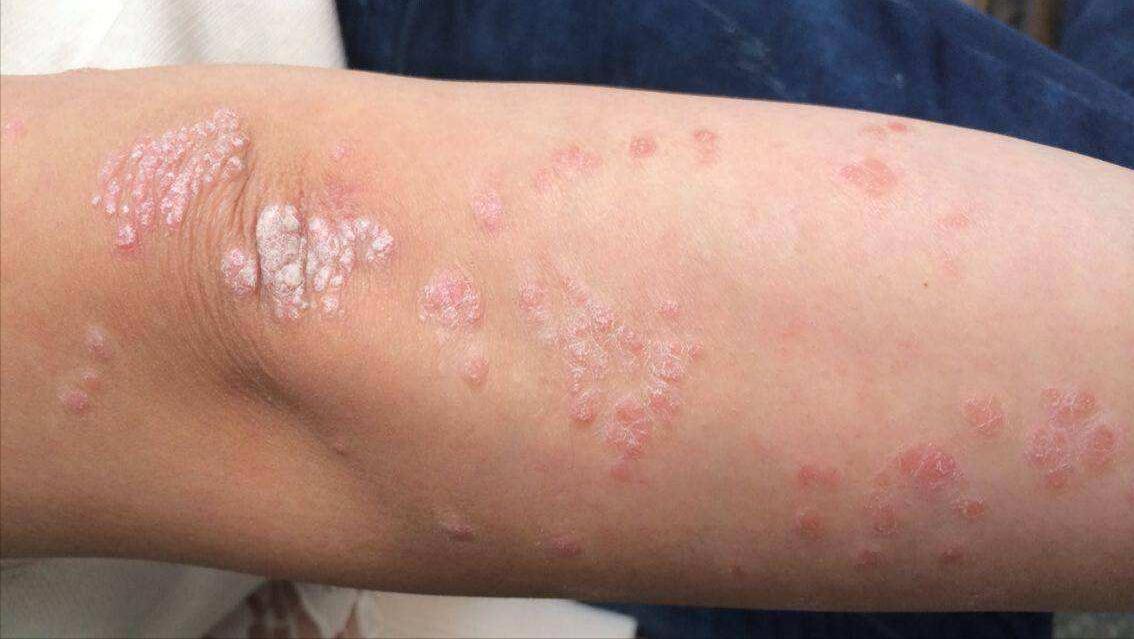 银屑病想要好这三点要知道,银屑病不可怕找到三个原因