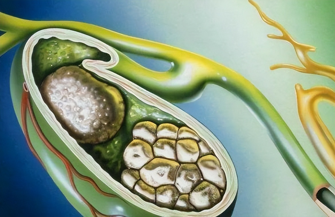 输尿管结石的饮食禁忌事项介绍,胆囊结石微创手术后饮食禁忌