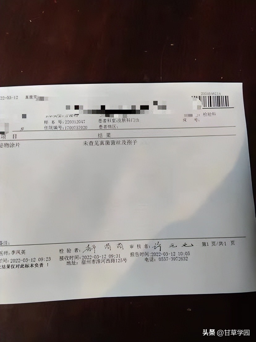 复方甘草治疗斑秃,甘草煮水治疗斑秃效果好吗