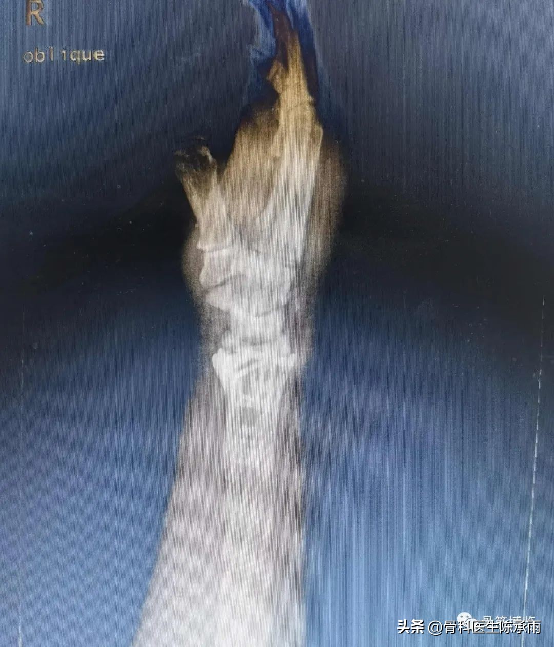 桡骨远端骨折伸直型的复位及固定,掌骨骨折外固定支架恢复