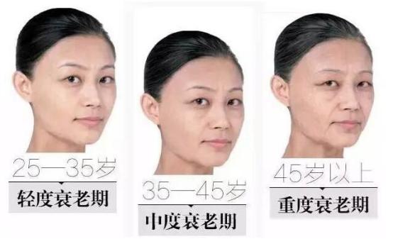 悬吊提升和线雕哪个好,线雕提升的作用与副作用