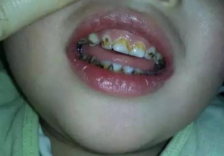 小孩牙齿有牙菌斑发黄怎么办,天天保持不偷懒早晚刷牙少吃糖