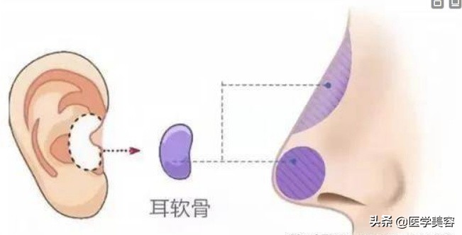耳软骨隆鼻会被吸收吗,用耳软骨隆鼻还需要加别的材料吗