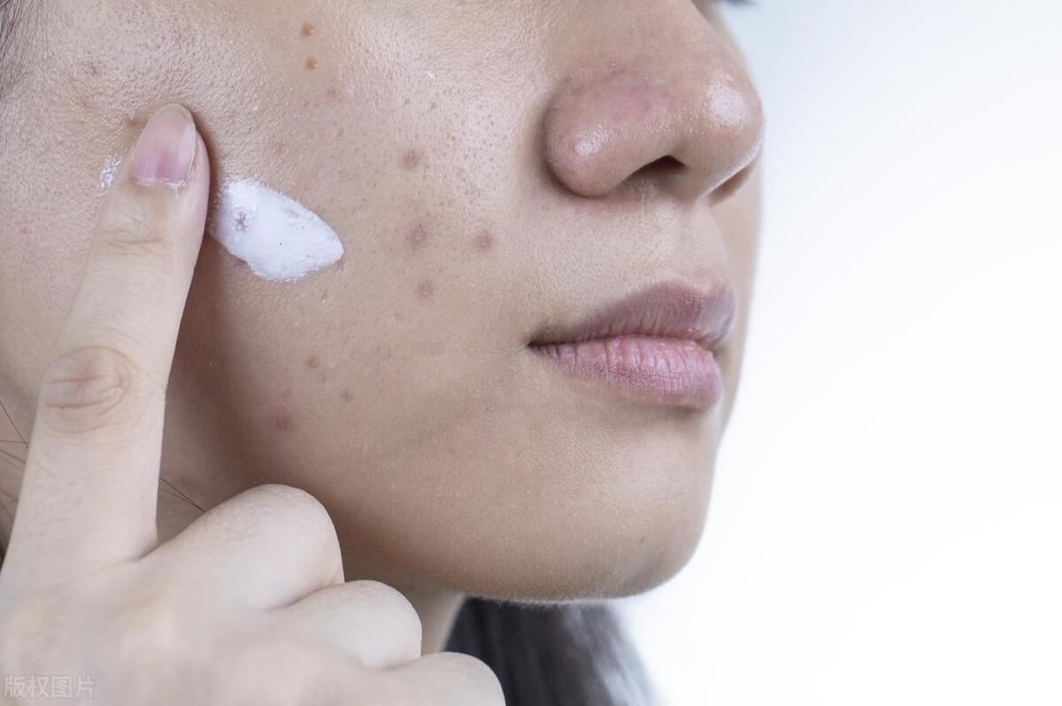 痘印痘疤不用药怎样才能消除更快,治疗痘痘痘印的最有效的药膏