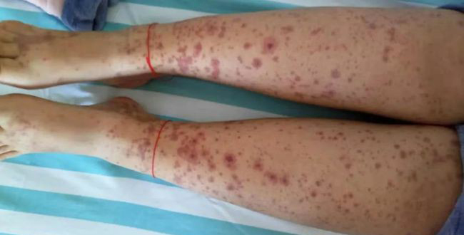 儿童过敏性紫癜关节型,儿童过敏性紫癜视频