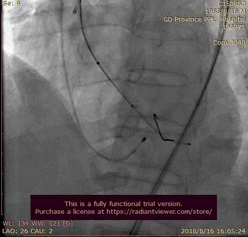 主动脉瓣狭窄的典型三联征表现,主动脉瓣狭窄治疗新技术