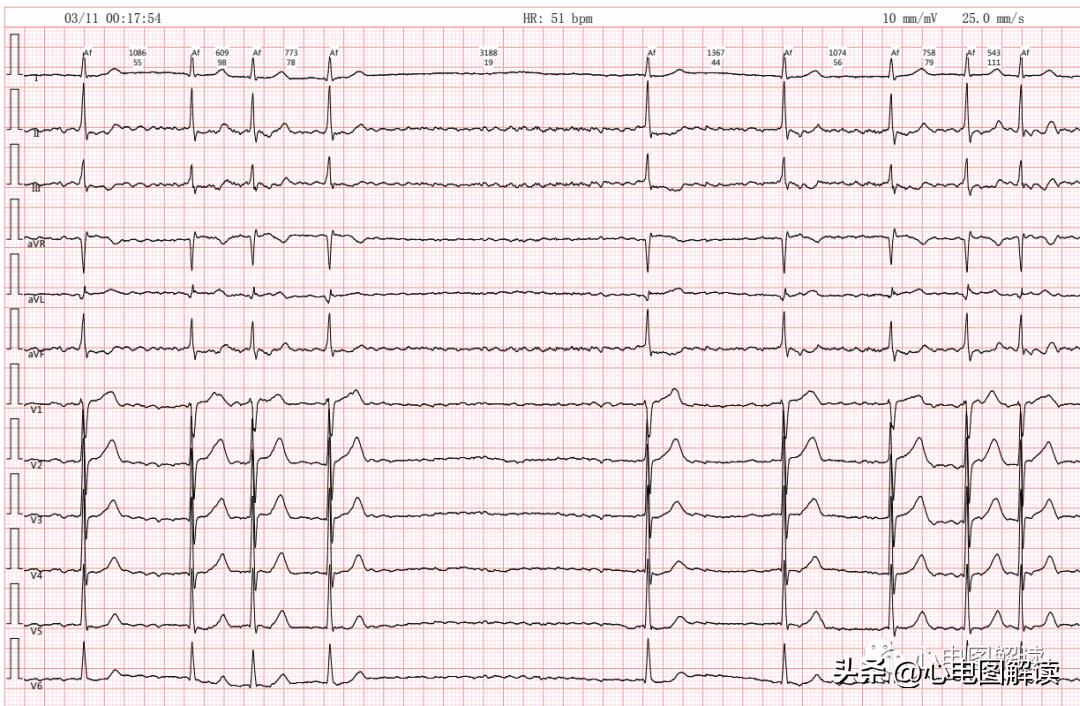 心房颤动伴长间歇能做射频消融吗,心房颤动伴停搏严重么